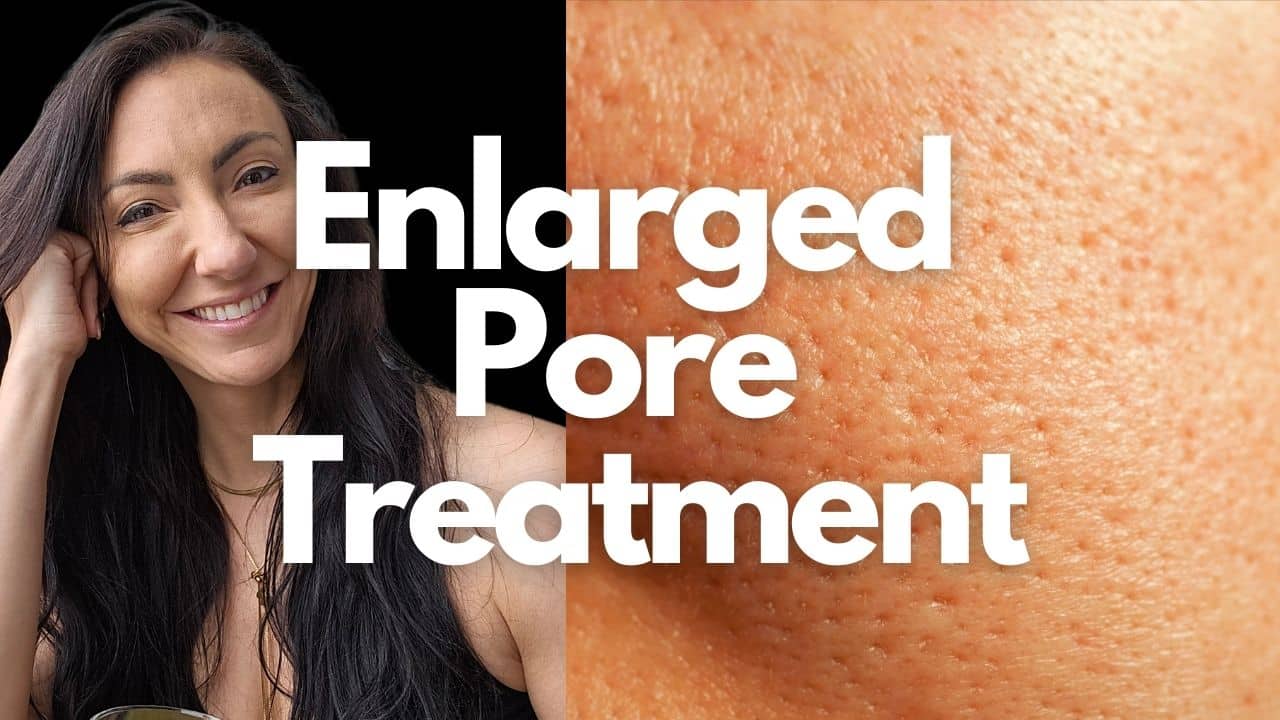 Enlarged Pore Treatment