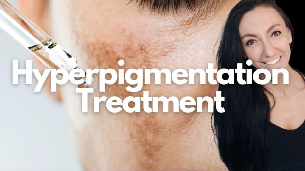 Hyperpigmentation Treatment Sparkle Moncton