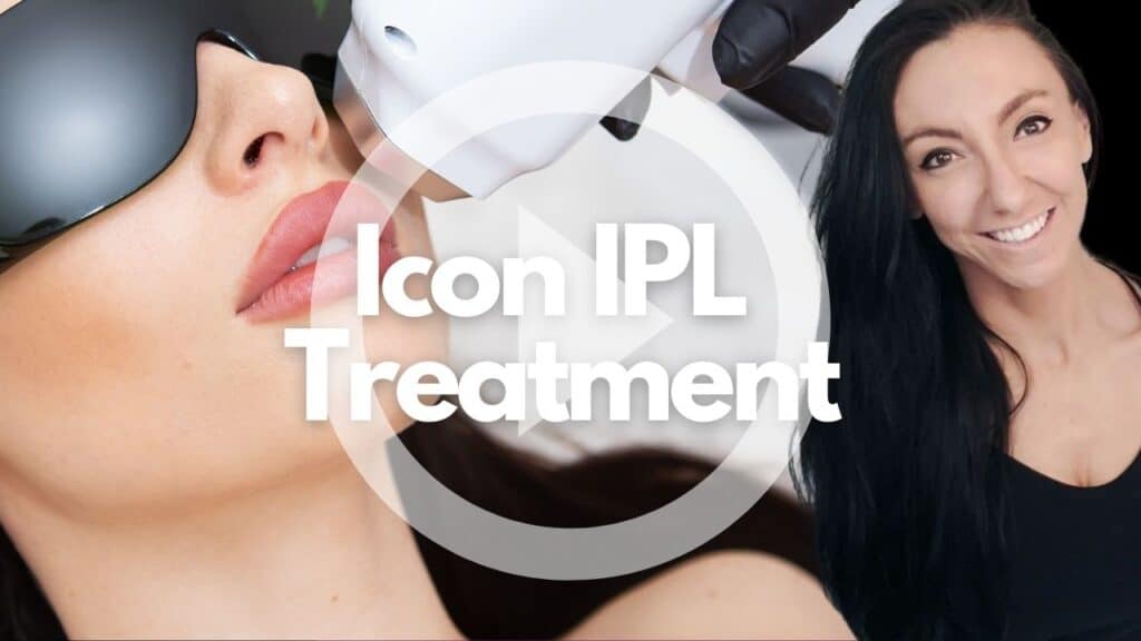 ICON™ IPL Skin Revitalization in Moncton, NB