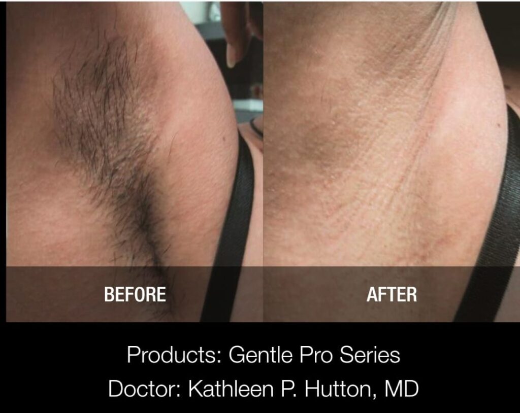 Laser Hair removal Moncton Before After