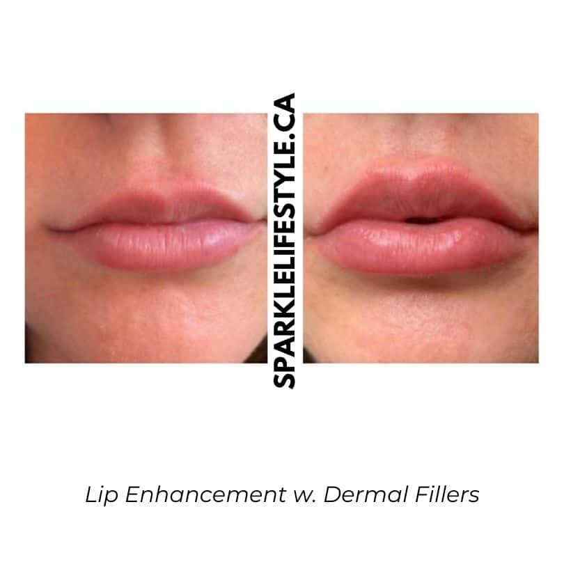 Lip Enhancement w. Dermal Fillers