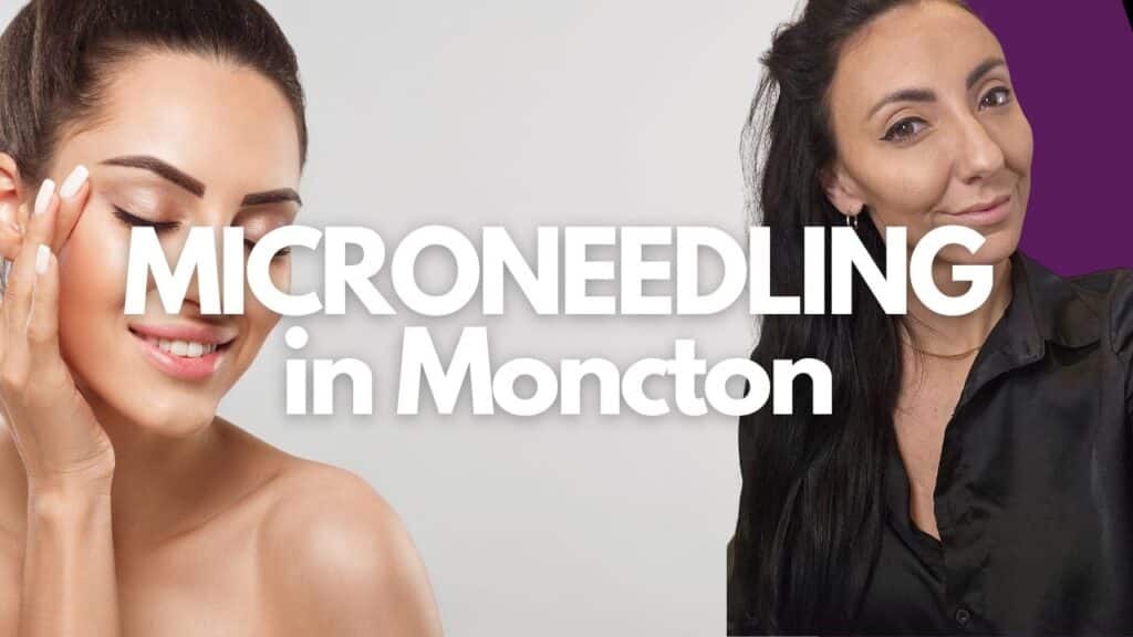 Microneedling Moncton