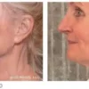 Osmosis-Recovery-Before-After