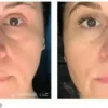 Osmosis-Recovery-Before-After-2