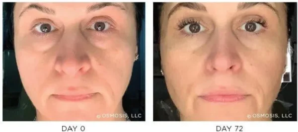 Osmosis-Recovery-Before-After-2 Osmosis-Recovery-Before-After-2