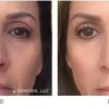 Osmosis-Recovery-Before-After-3