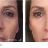 Osmosis-Recovery-Before-After-3