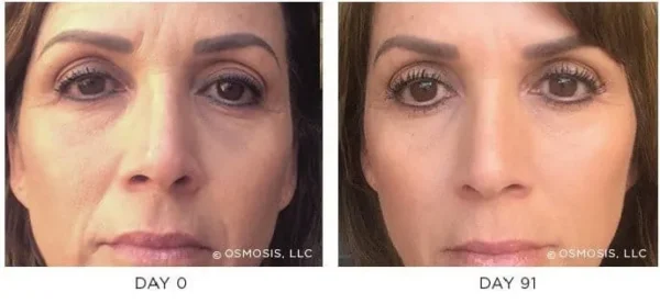 Osmosis-Recovery-Before-After-3 Osmosis-Recovery-Before-After-3