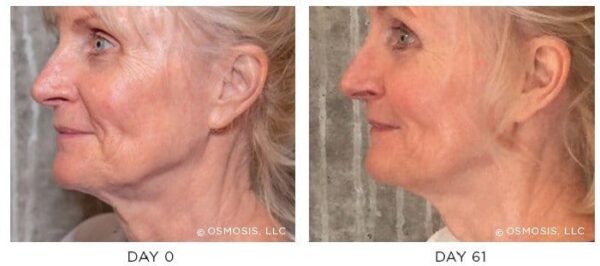 Osmosis-Recovery-Before-After.jpg Osmosis-Recovery-Before-After.jpg