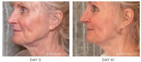Osmosis-Recovery-Before-After Osmosis-Recovery-Before-After
