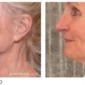 Osmosis-Recovery-Before-After