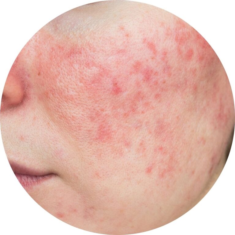 Rosacea Treatment Moncton