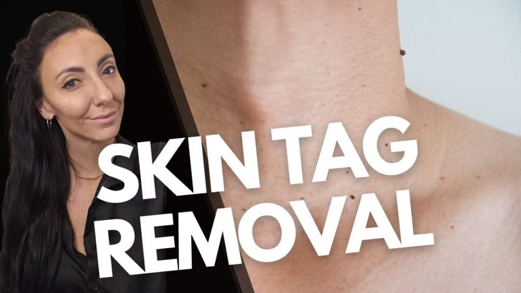 Skin Tag Removal Moncton