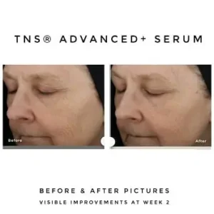 SkinMedica-TNS-Advanced-Serum-Before-and-After SkinMedica TNS Advanced Serum Before and After