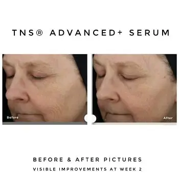 SkinMedica-TNS-Advanced-Serum-Before-and-After SkinMedica TNS Advanced Serum Before and After