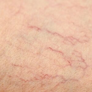 Spider Veins Treatment Moncton