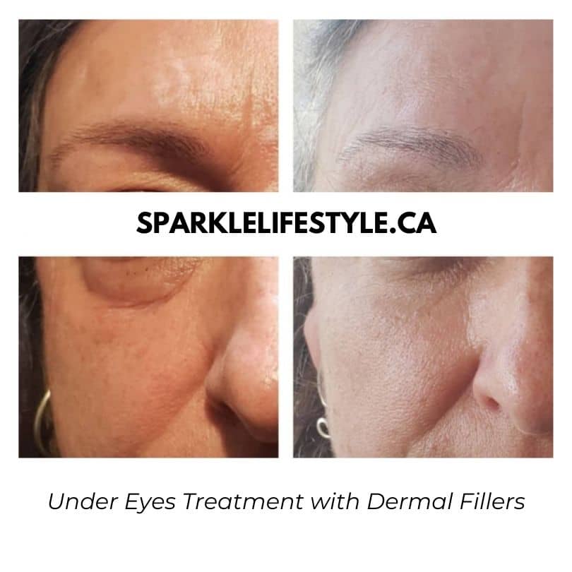 Under-Eyes-Treatment-with-Dermal-Fillers (1)