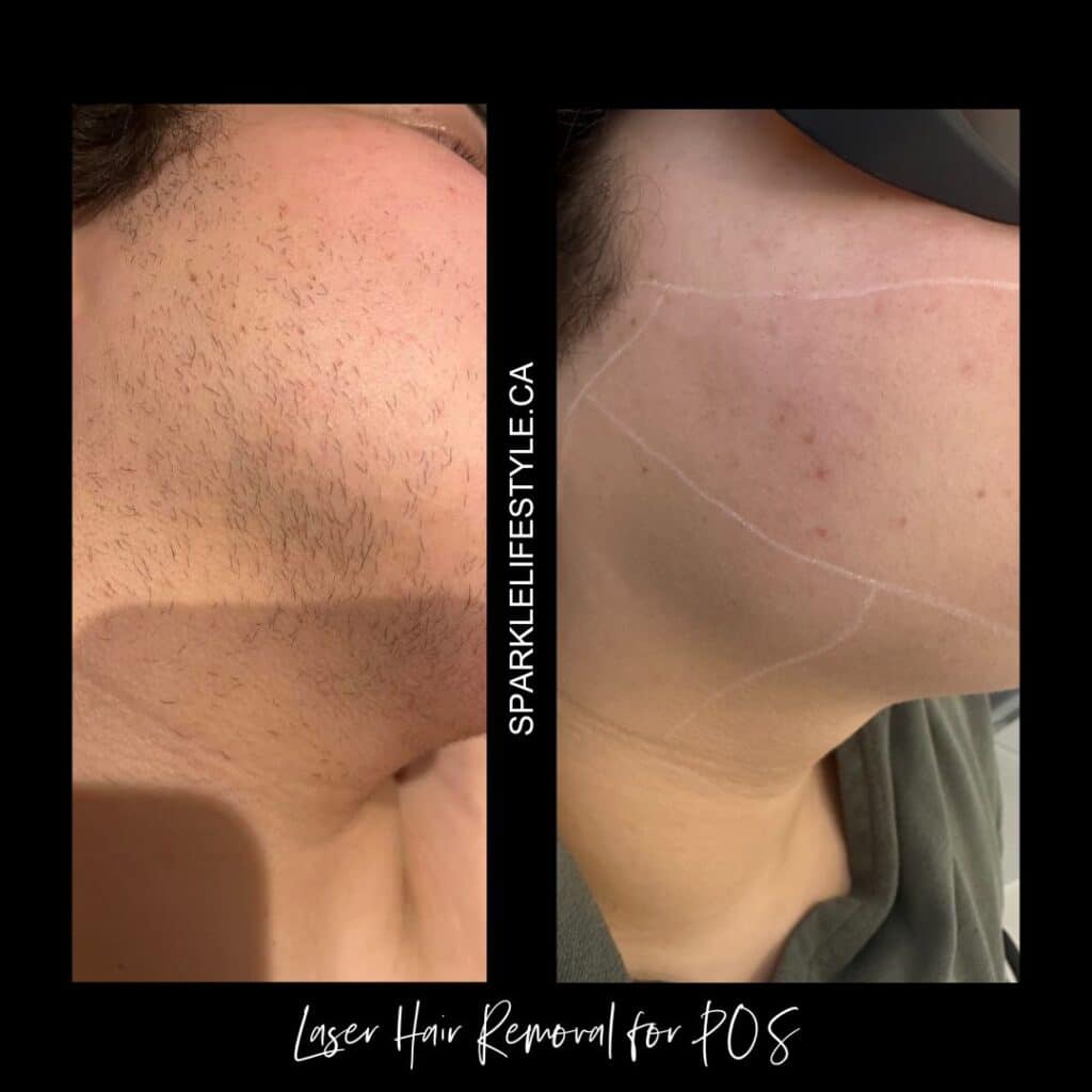 B&A Laser Hair Removal 7 total sessions (taken 3-4treatments in)