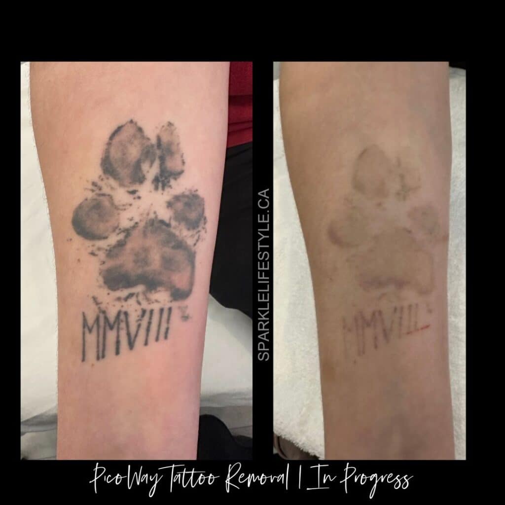 PicoWay Laser Tattoo Removal Before After Sparkle Moncton