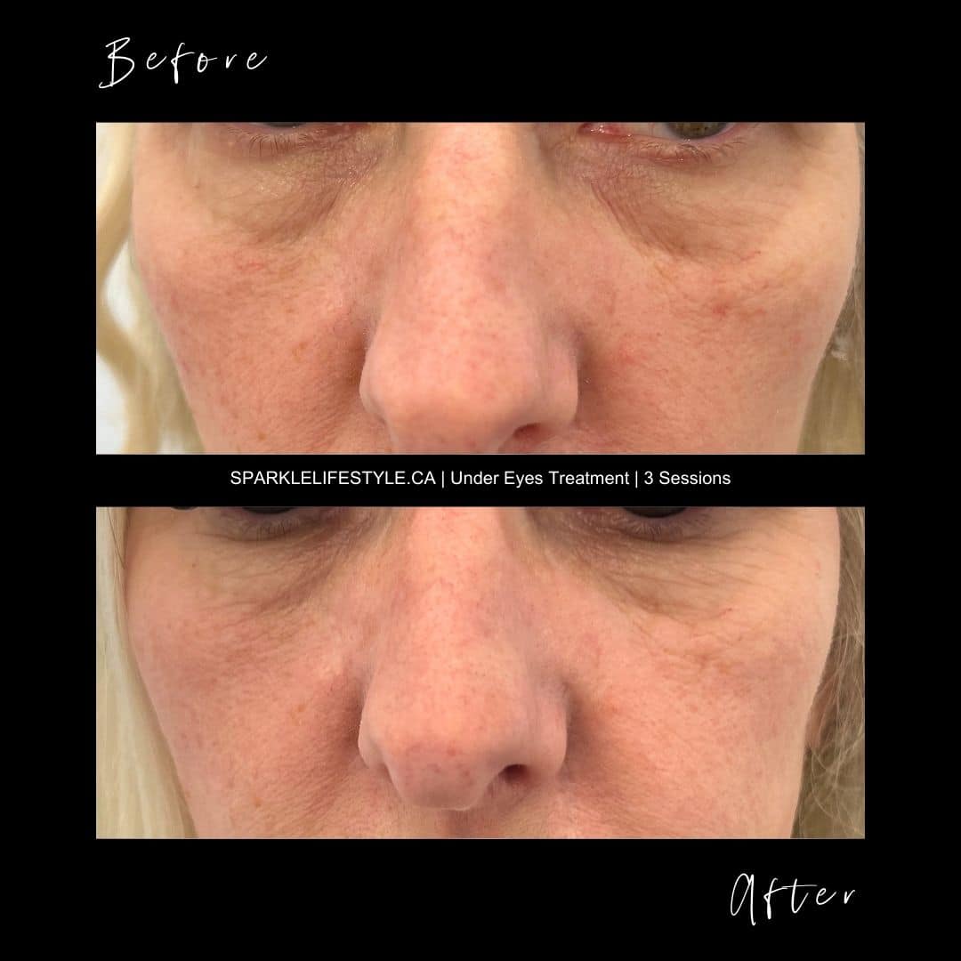 Under Eyes Bag Treatment Before After 3 sessions