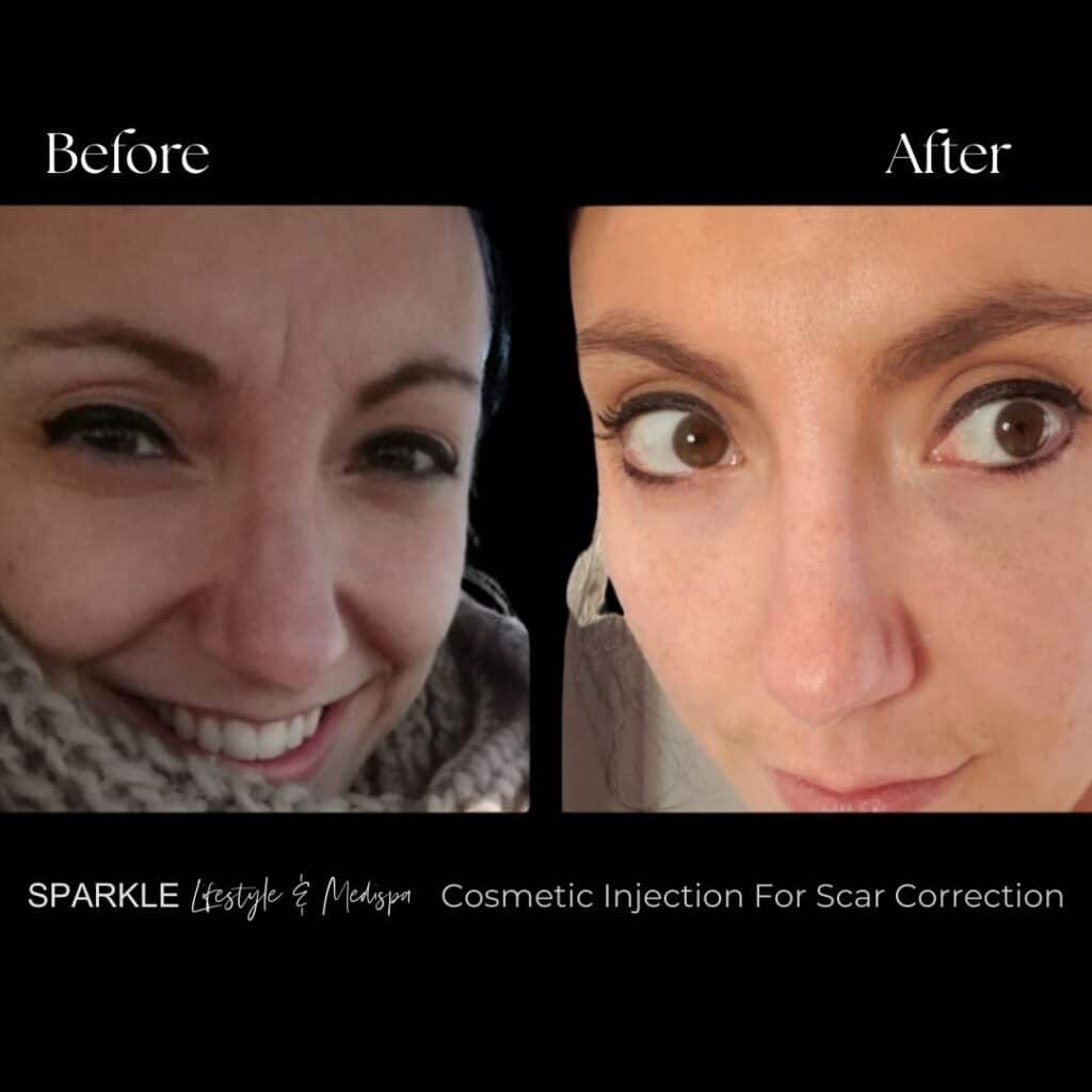 Botox Treatment for For Scar Correction Sparkle Moncton NB