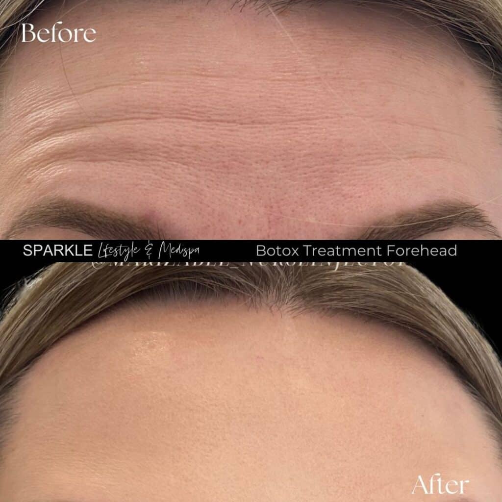 Botox Treatment for Forehead Lines Sparkle Moncton