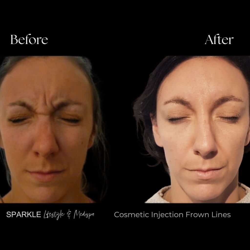 Botox Treatment for Frown Lines Sparkle MediSpa Moncton NB
