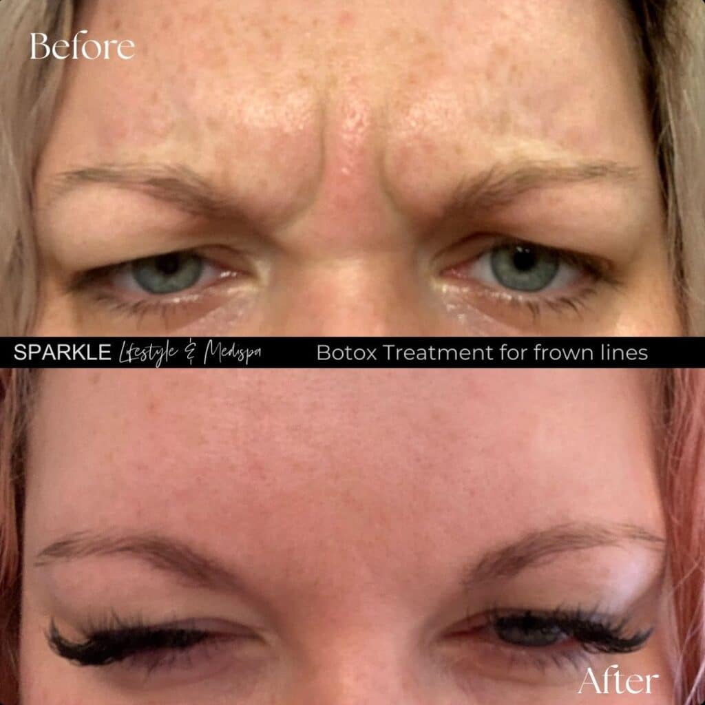 Botox Treatment for Frown Lines Sparkle Moncton