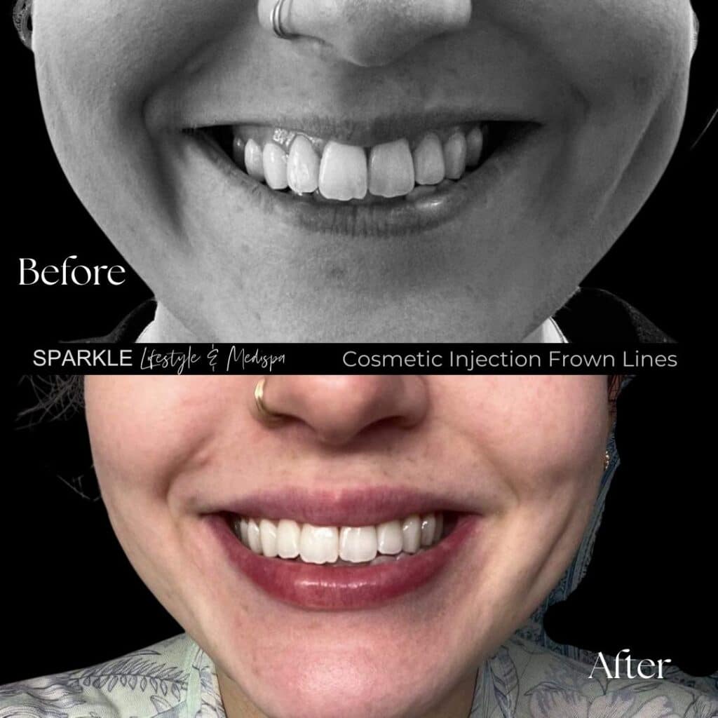 Botox Treatment for Gummy Lines Sparkle MediSpa Moncton NB