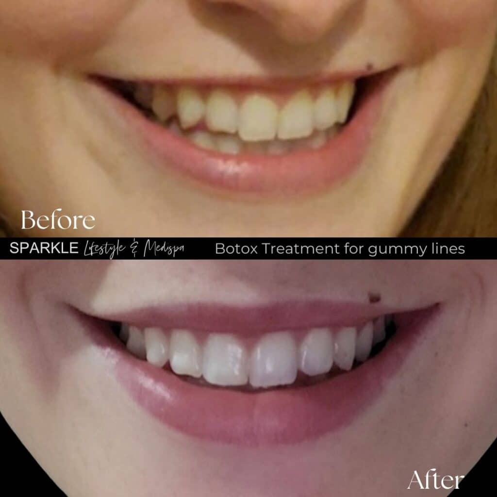 Botox Treatment for Gummy Lines Sparkle Moncton