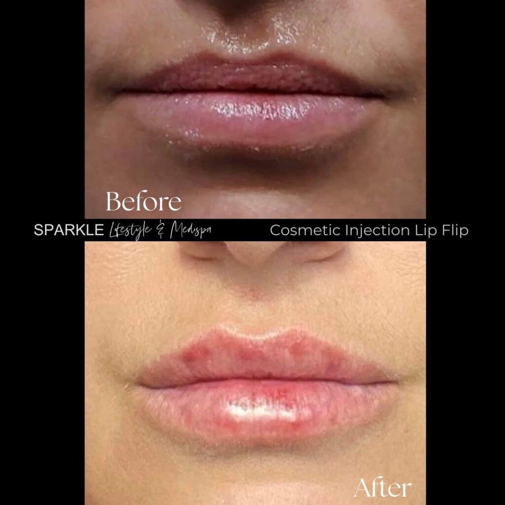 Botox Treatment for Lip Flip Sparkle Moncton NB