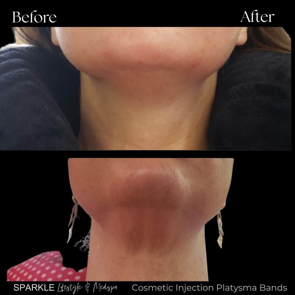 Botox Treatment for platysma bands Sparkle Moncton NB