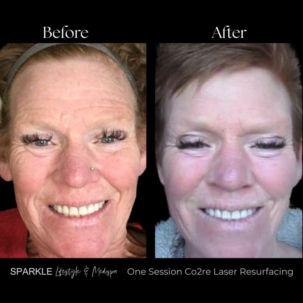 Co2 Laser Full Face Treatment Sparkle Moncton Before & After