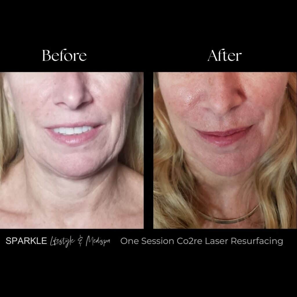 Co2 Laser Full Face Treatment Sparkle Moncton Before & After (2)