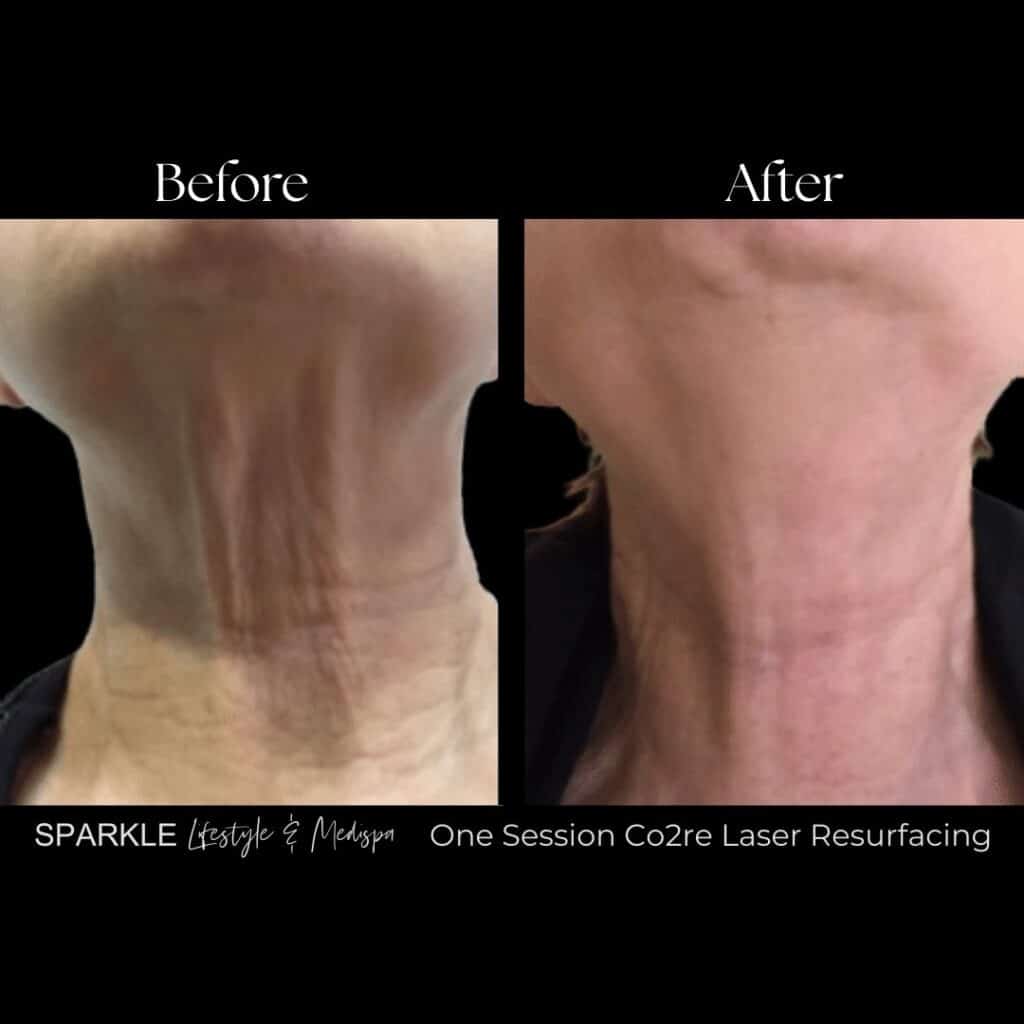 Co2 Laser Neck Treatment Sparkle Moncton Before & After