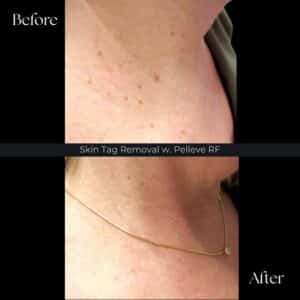 Skin Tags Removal Before After Sparkle Lifestyle MediSpa Moncton NB 2