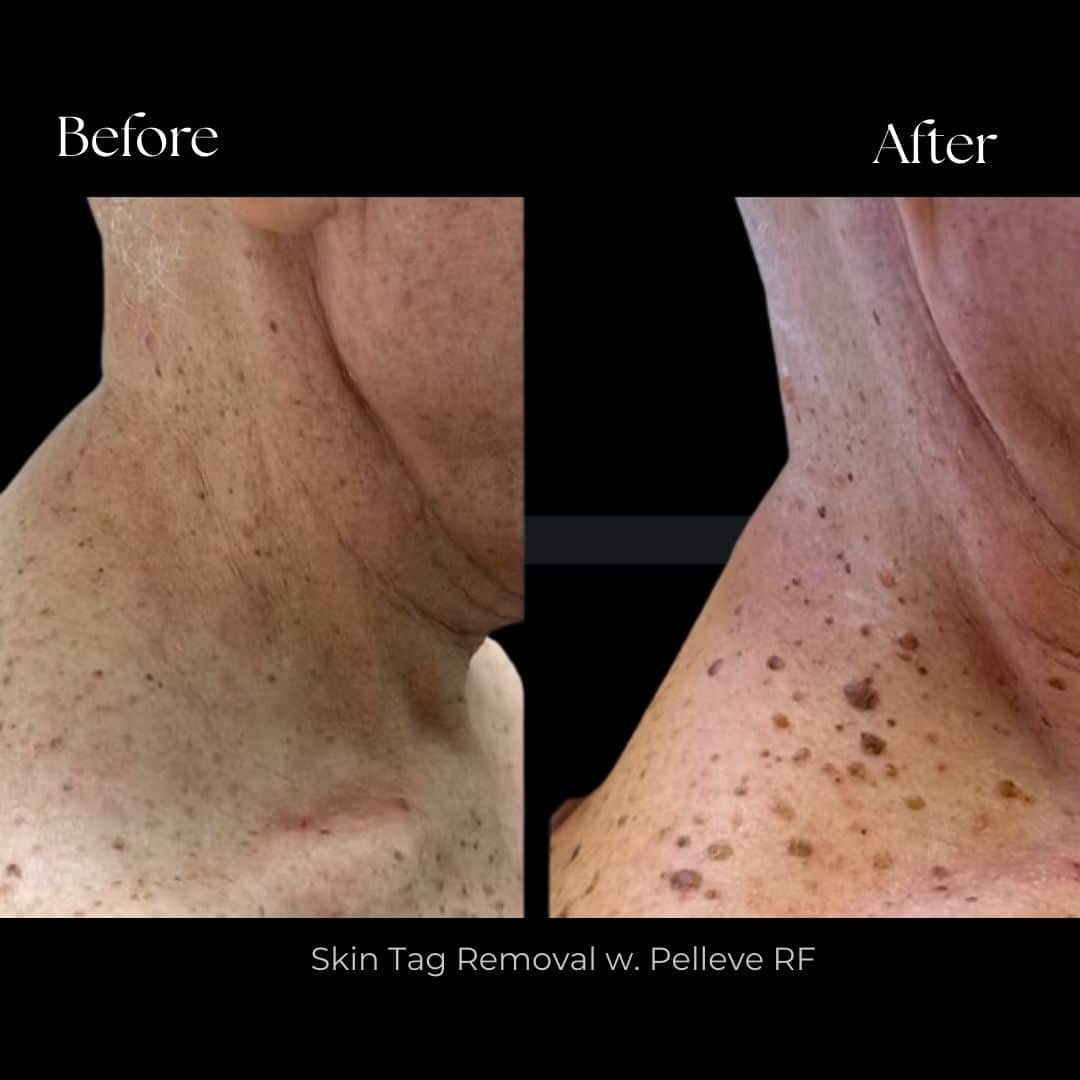 Skin Tags Removal Before After Sparkle Lifestyle MediSpa Moncton NB
