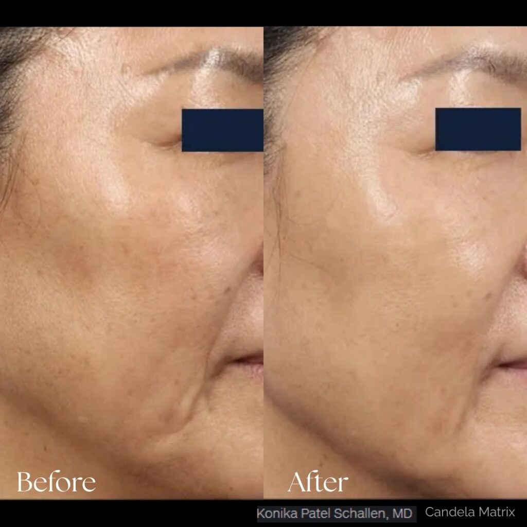 Matrix Pro RF Microneedling Before After Results Moncton NB