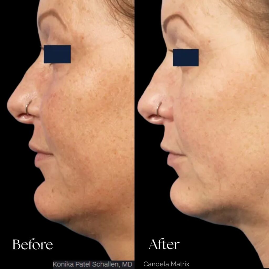 Matrix Pro RF Microneedling Before After Results Moncton NB (3)
