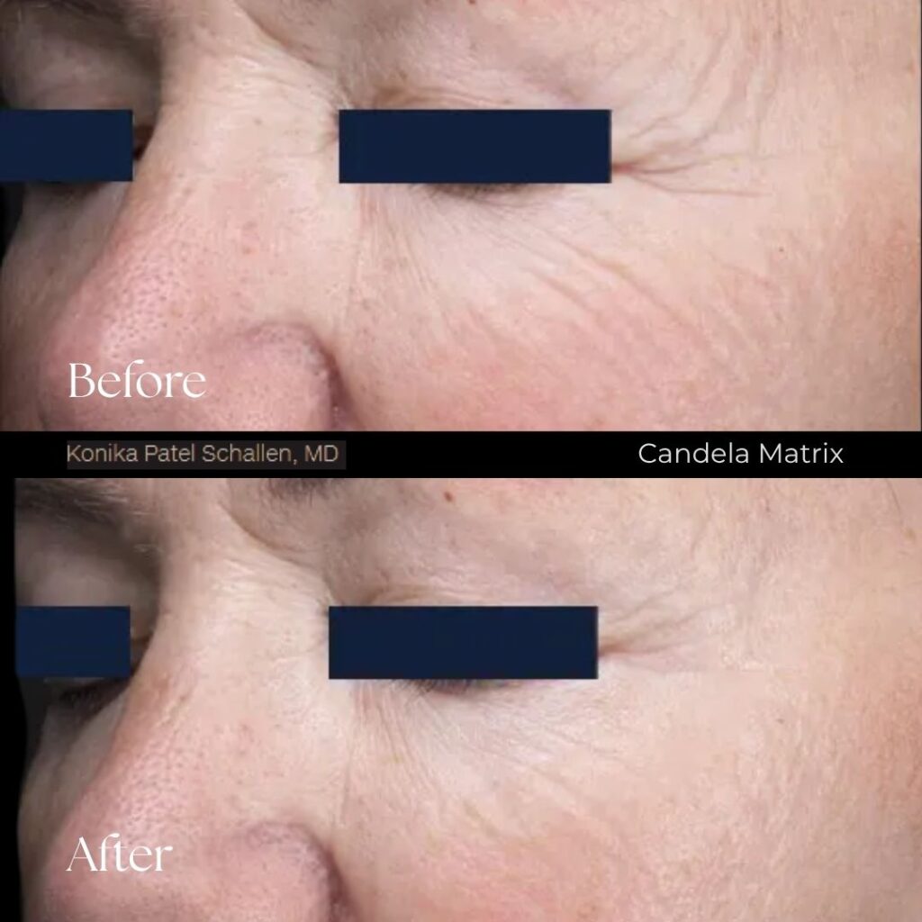 Matrix Pro RF Microneedling Before After Results Moncton NB (4)