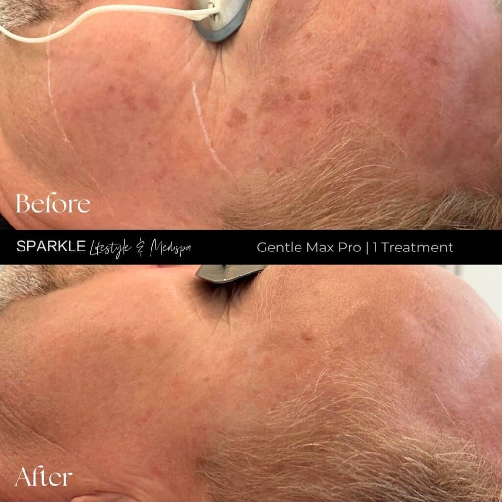 Before & After GMP Pigments in 1 treatment JOSIE