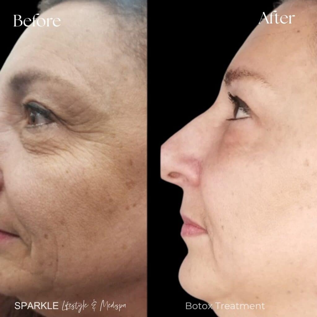 Botox Treatment for Crows Feets Sparkle Moncton