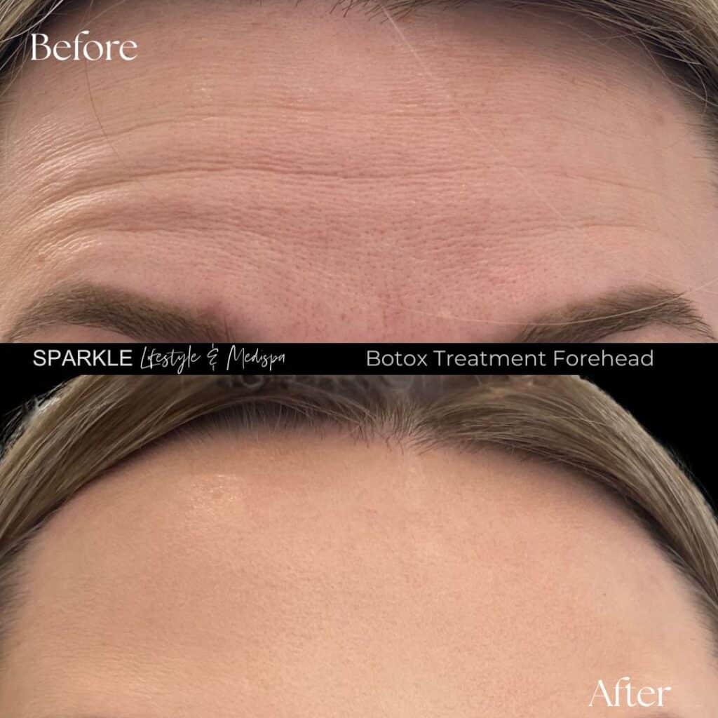 Botox Treatment for Forehead Lines Sparkle Moncton