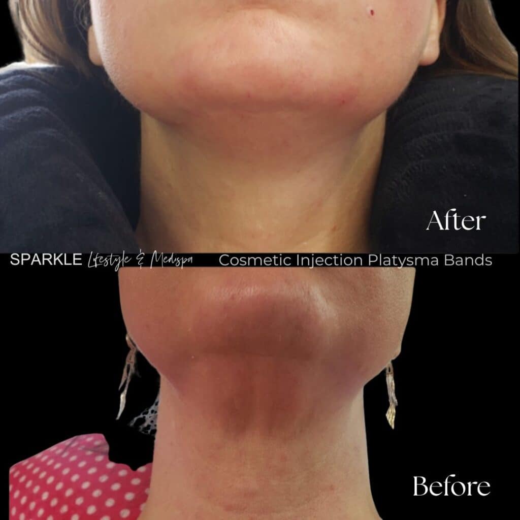 Botox Treatment for platysma bands Sparkle Moncton NB