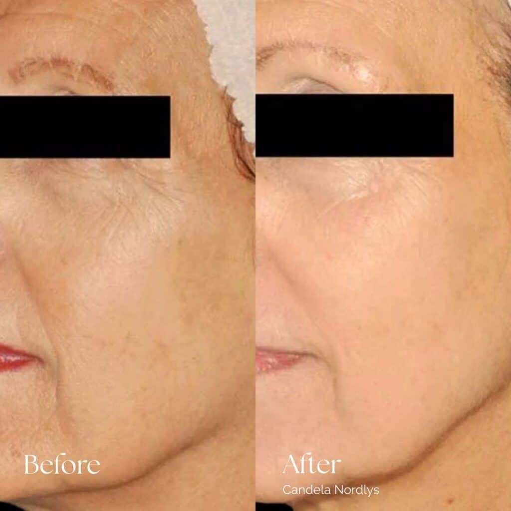 Candela Nordlys Before and After