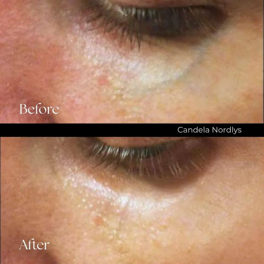Candela Nordlys Before and After