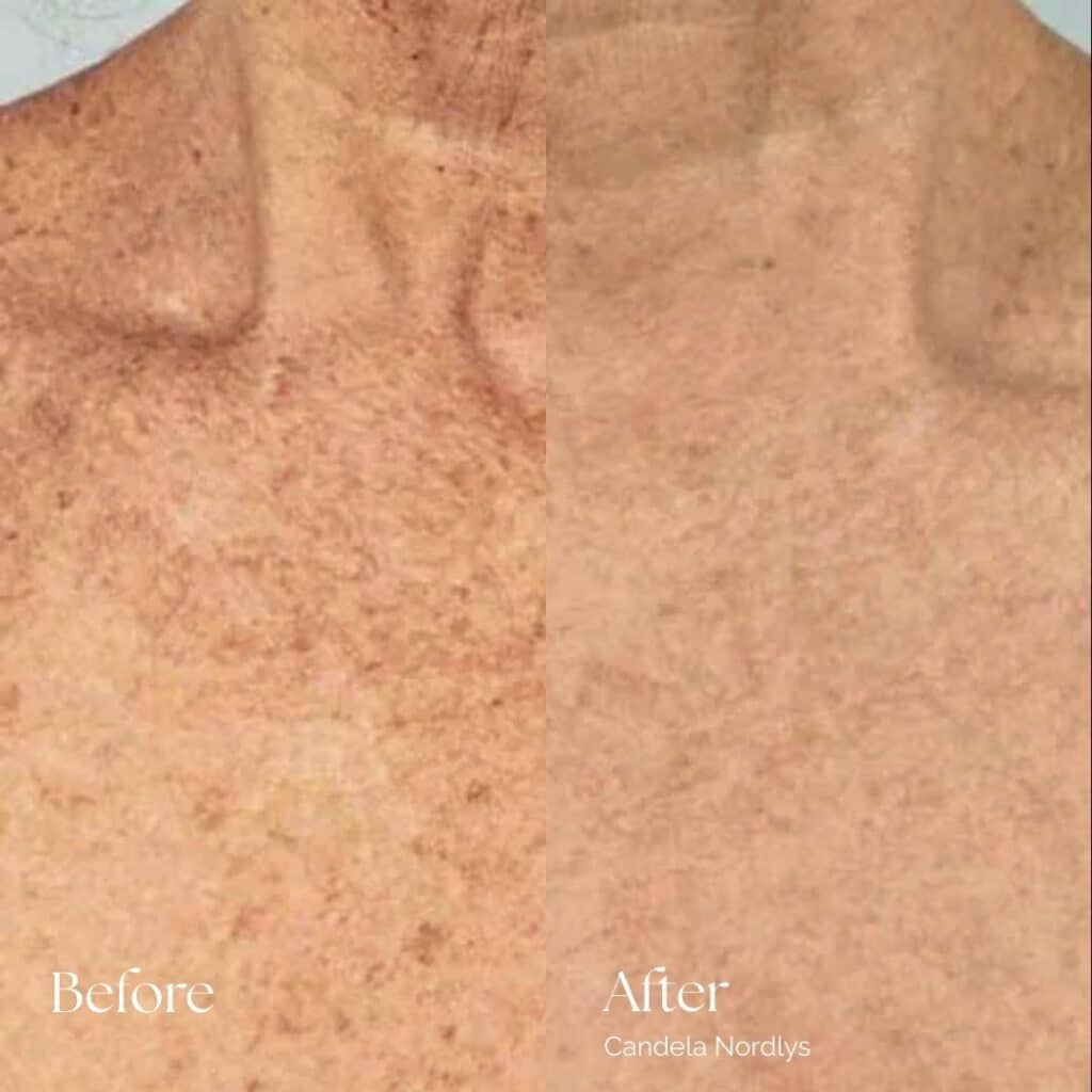 Candela Nordlys Before and After