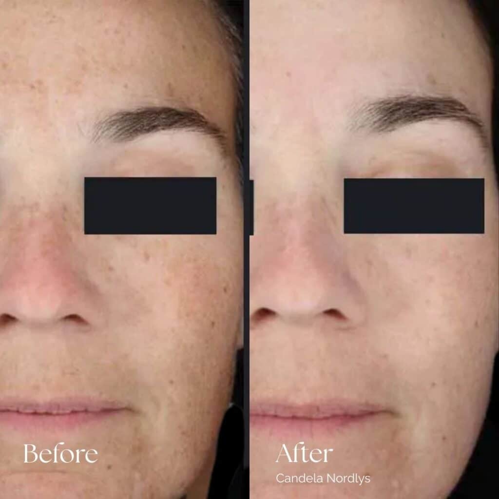 Candela Nordlys Before and After