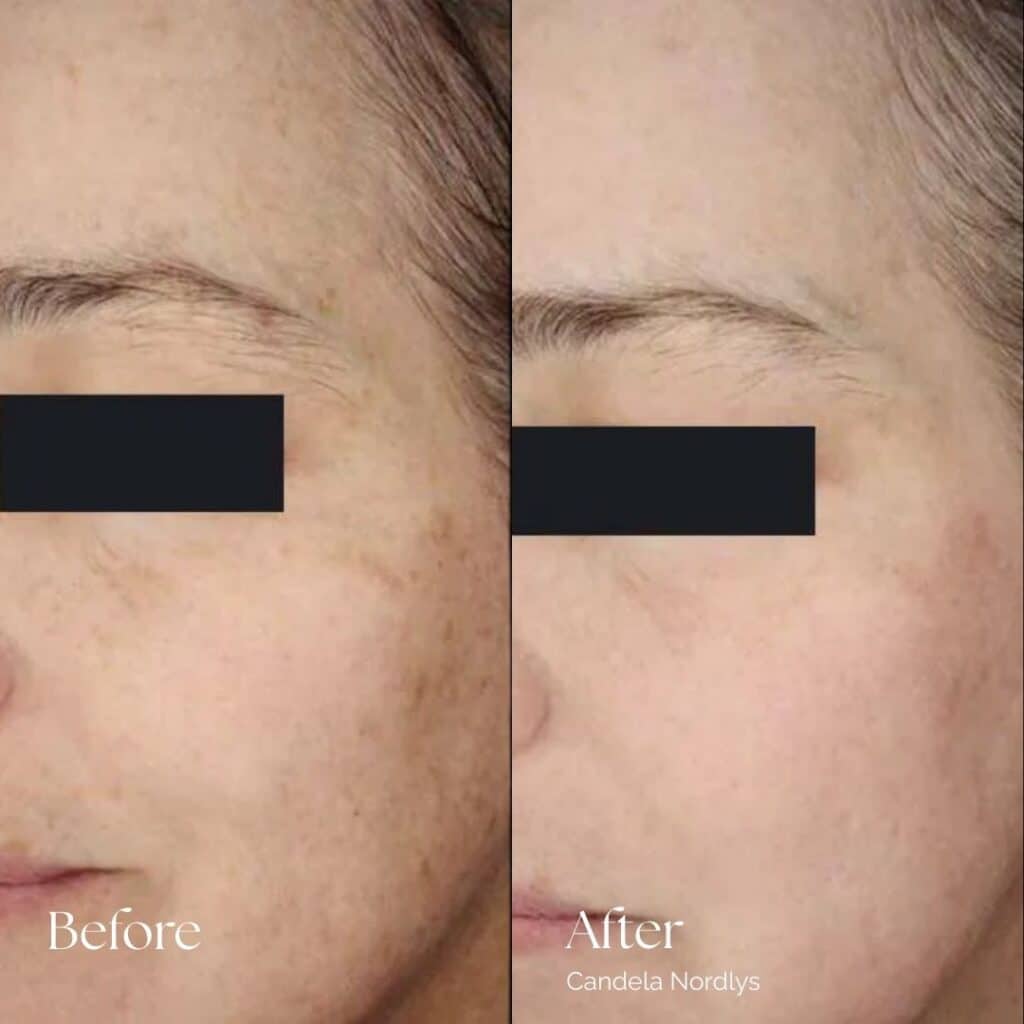 Candela Nordlys Before and After