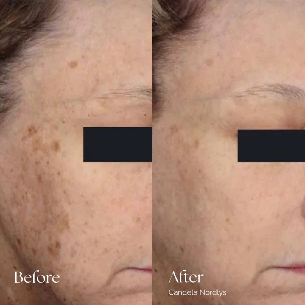 Candela Nordlys Before and After